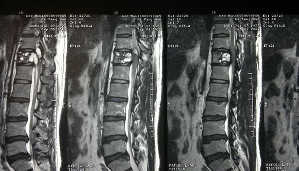 疼痛性脊柱转移性肿瘤日益受到重视