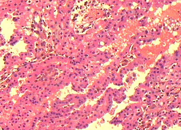 乳头状肾细胞癌36例临床病理分析