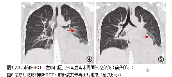 19岁男性患混合性结缔组织病相关心肌炎入院治疗病例分析