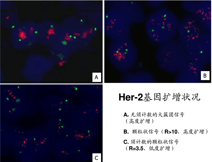 荧光原位杂交在乳腺癌中的应用