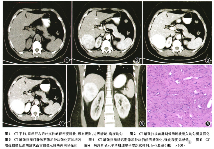 cT检查肝脏体积,外形正常,表面光滑,肝左叶缩小