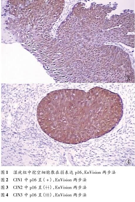 238例宫颈细胞学和组织学对照分析及p16在组织学诊断中的应用