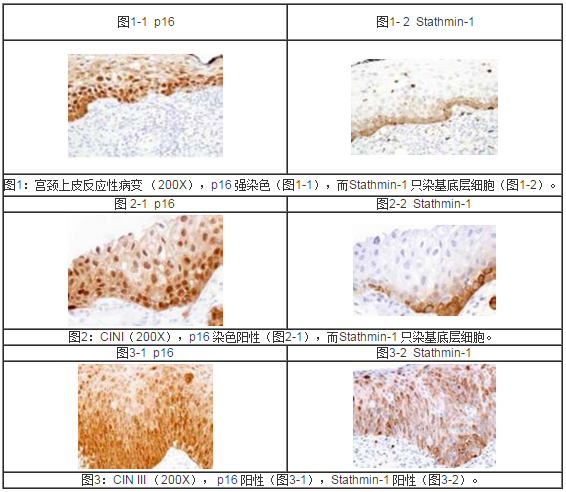 x 采用免疫组化标记物鉴别宫颈癌前病变,特别是高级别病变与低级别