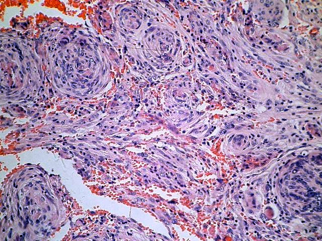 x    脑膜瘤(meningiomas)很常见,占颅内肿瘤的15.31%,仅次于胶质瘤.