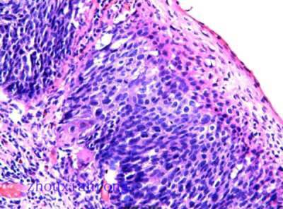 周先荣:《子宫颈鳞状上皮肿瘤—微小浸润癌的诊断》(一)