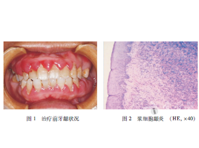 48岁女性患浆细胞性龈炎入院治疗病例分析