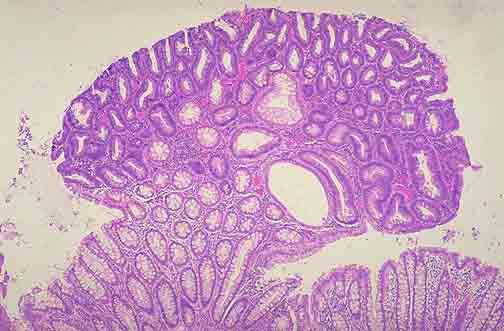 x    管状腺瘤又称"腺瘤性息肉",是大肠腺瘤中最常见的一种.