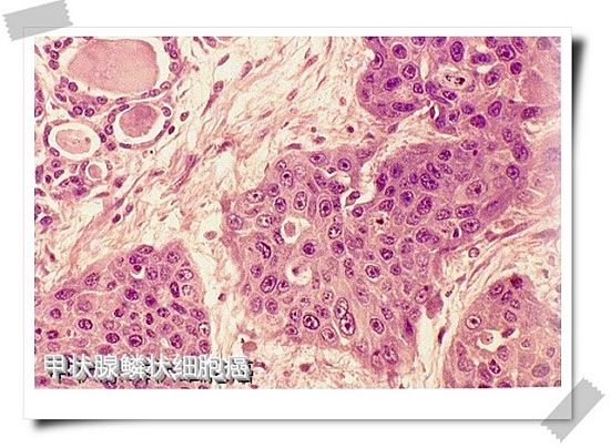 甲状腺鳞状细胞癌切片