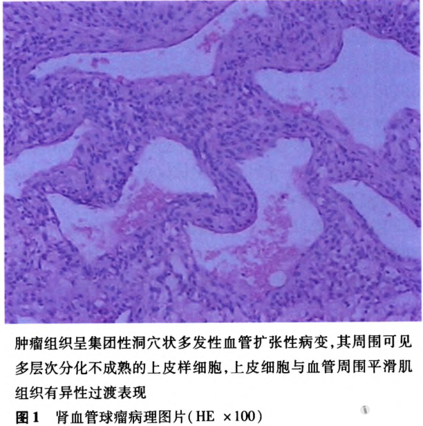 37岁男性患肾血管球瘤入院治疗病例分析