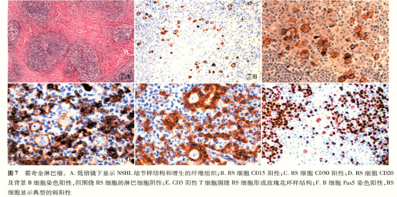 cd5阳性有助于mcl和sll的鉴别诊断,ihc双染可对一些难以辨认的细胞