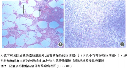 67岁男性患阴囊多形性脂肪瘤伴发纤维瘤入院治疗病例分析