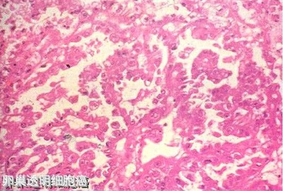 富含糖原的透明细胞和鞋钉样细胞组成的卵巢表面上皮-间质性恶性肿瘤