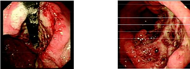 图3-102 胃角a2期大溃疡,深凹陷,底苔污秽,直径>2cm,边缘陡峭,有新生
