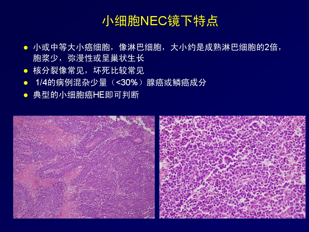 胃肠胰腺神经内分泌癌肿瘤的病理学诊断