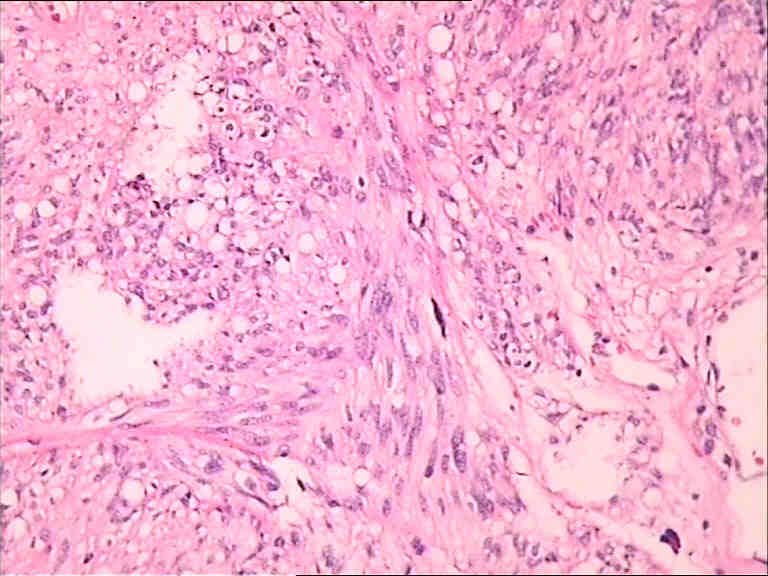 间质瘤 病理杂谈 91360病理论坛