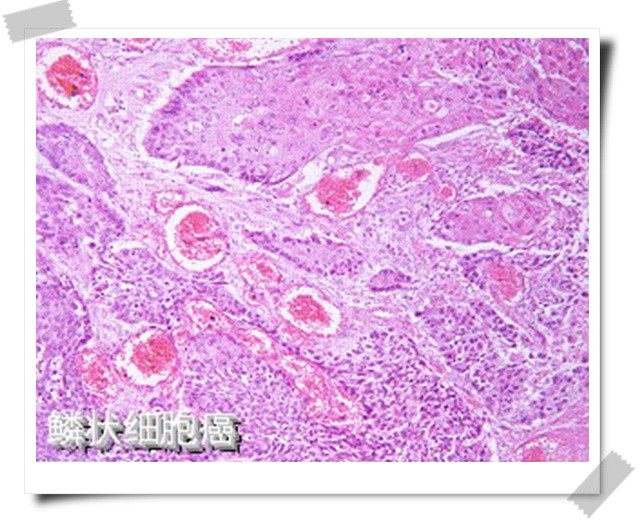 胆囊鳞状细胞癌一例临床病理分析