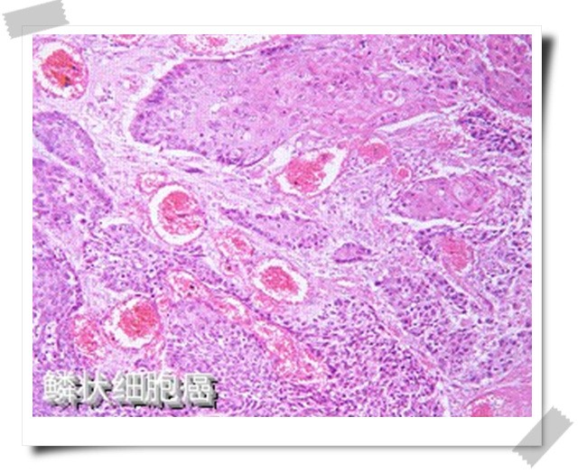 膀胱鳞状细胞癌切片
