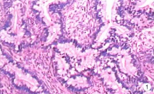 宫颈管内膜型腺癌的组织学分型