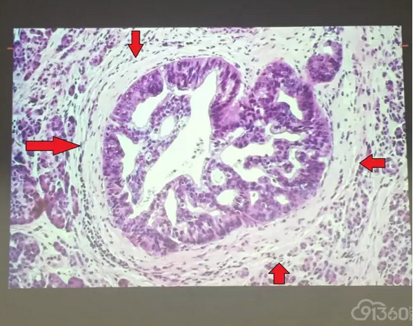 胰腺病理新进展写在郑建明主任讲座之后