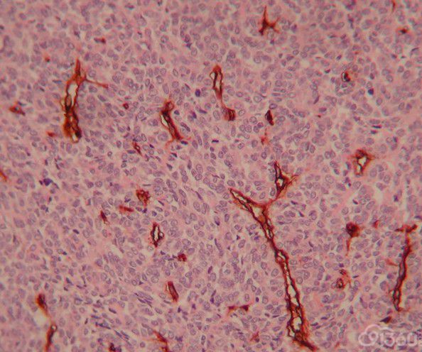 血管肉瘤 病理杂谈 91360智慧病理网
