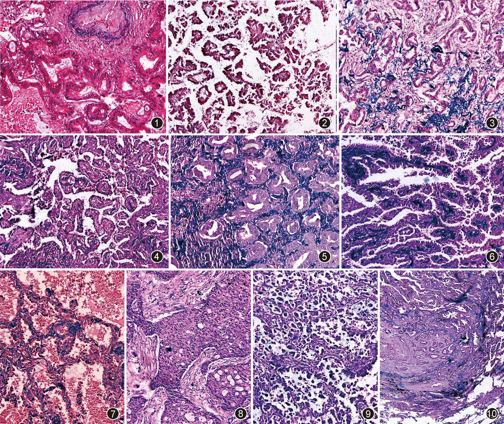 图1～10肺腺癌弹力纤维分级 弹力纤维染色 中倍放大