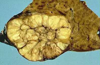 肝局灶性结节性增生(fnh)位居肝脏原发良性肿瘤发病率第二,女性