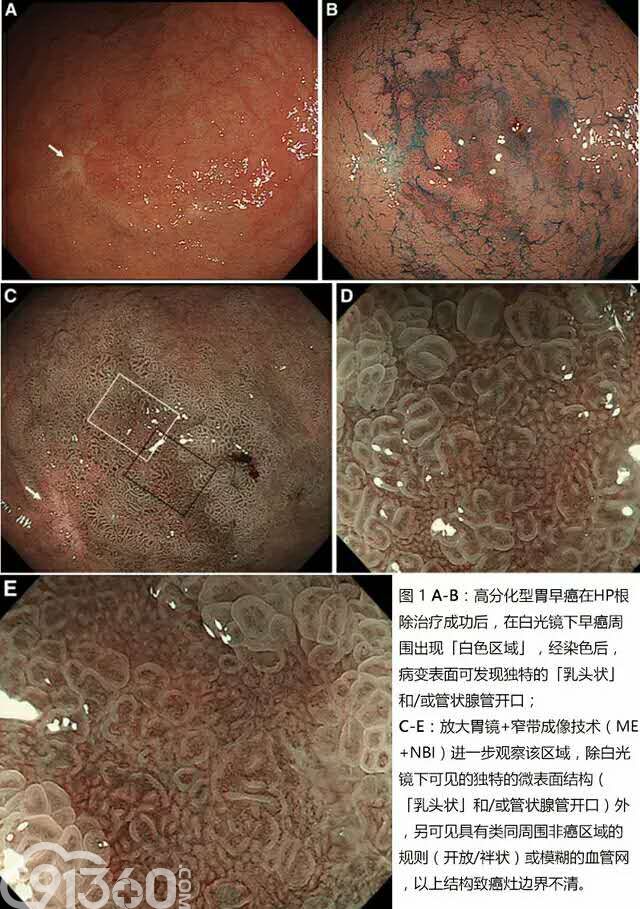 7个病例识别幽门螺杆菌根除后早期胃癌的形态改变