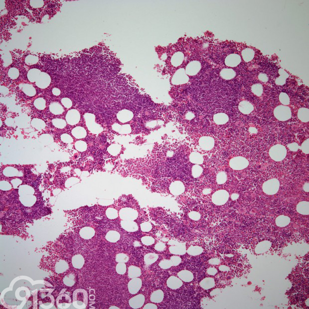 图3 骨髓活检显示弥漫性淋巴细胞白血病受累