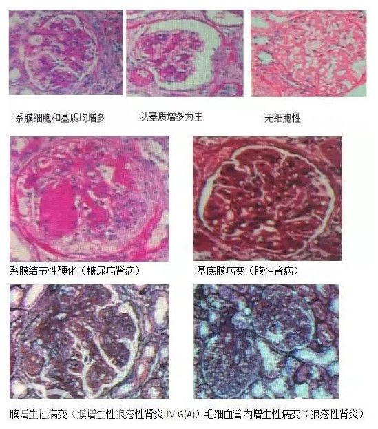 陈文芳:如何阅读肾脏病理报告