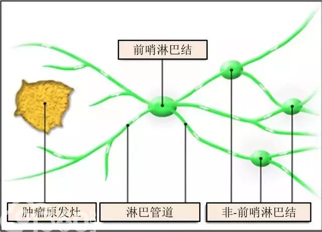 前哨淋巴结和前哨淋巴结活检