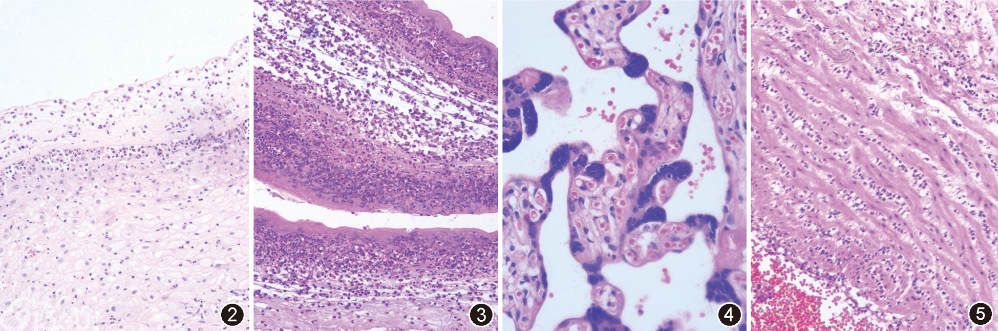 组织学绒毛膜羊膜炎病理改变与新生儿感染的关系