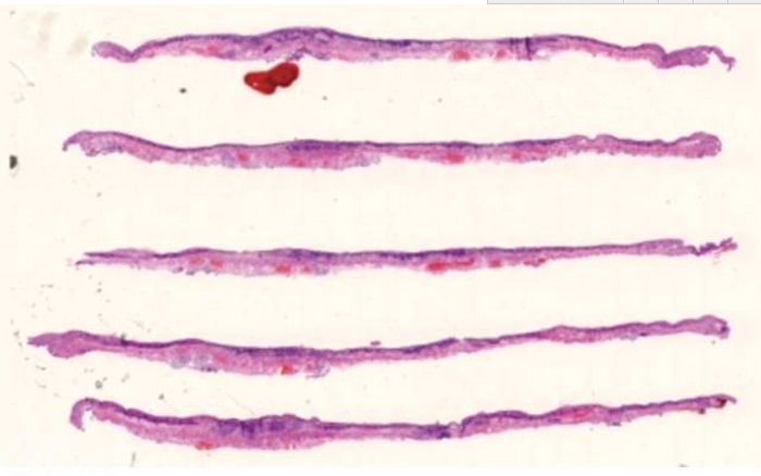 早期食管鳞状细胞癌及癌前病变筛查与诊治共识(2015年·)【二