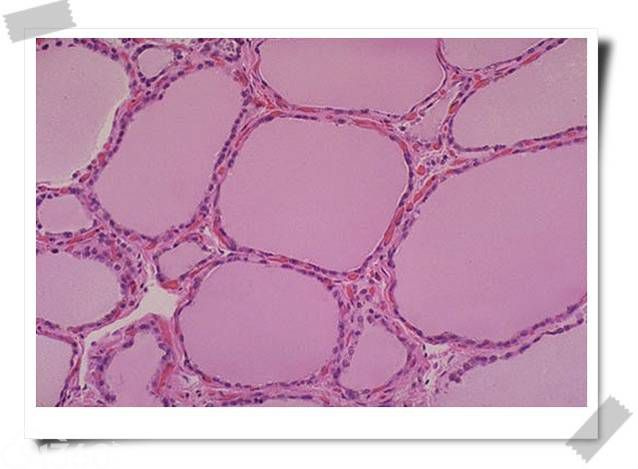 正常甲状腺滤泡:正常甲状腺滤泡内衬立方上皮,这些上皮细胞可分泌或
