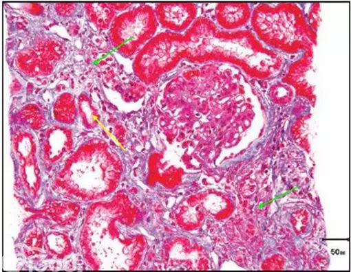 肾内病理图解:iga肾病