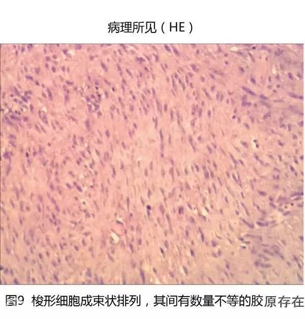 右侧胸壁侵袭性纤维瘤1例 - 病理杂谈 - 91360智慧