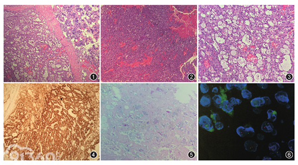 s-100蛋白,ck8,stat5a(图4)阳性,ki-67阳性指数3%～5%,ema,α1