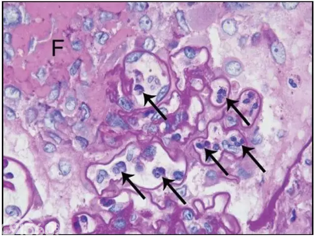 肾内病理图解anca相关性血管炎介导新月体性肾炎
