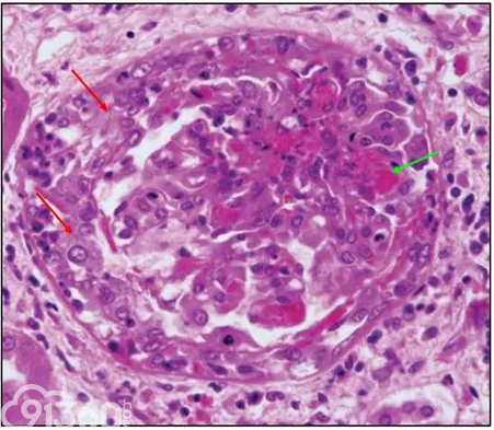 新月体性肾小球肾炎
