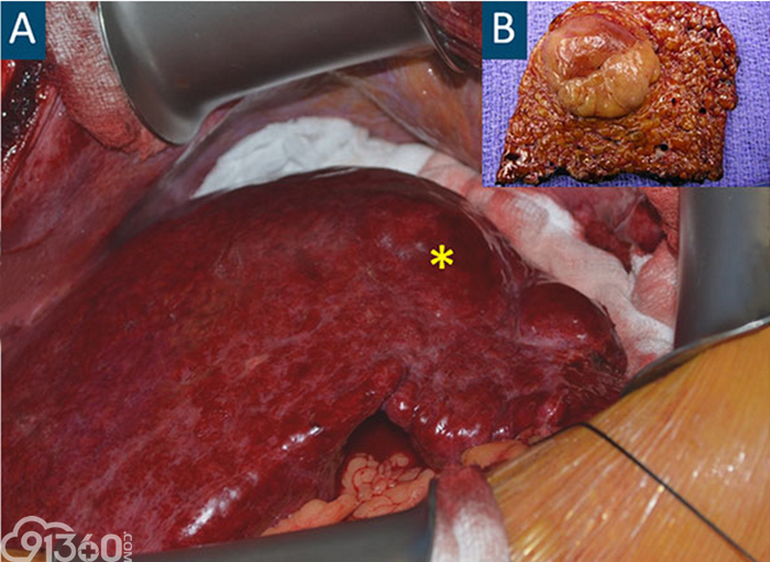 图a中的星标代表肝硬化结节,图b是肝癌切除术后标本,注意肿瘤外层包膜