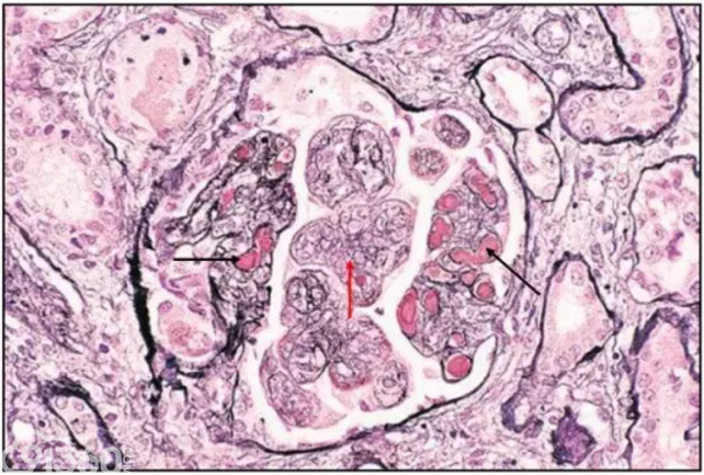 狼疮性肾炎病理图