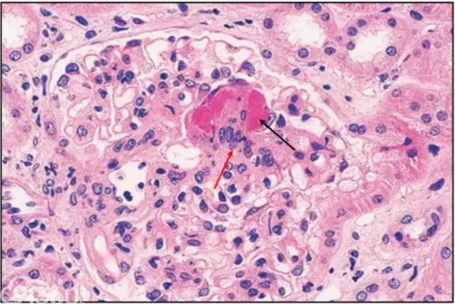 狼疮性肾炎病理图