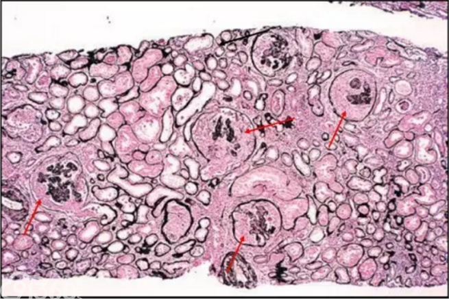 狼疮性肾炎病理图