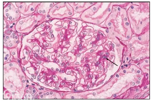 精彩病理图:i~vi 型狼疮性肾炎