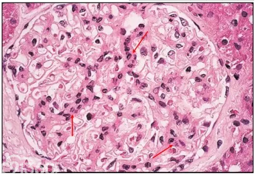 精彩病理图:i~vi 型狼疮性肾炎