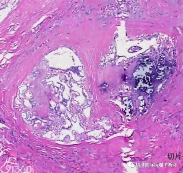 穿刺后的乳头状癌病理