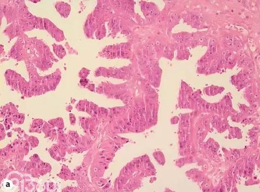 粘液性囊腺癌的组织学切片