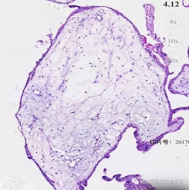 葡萄胎? - 病理杂谈 - 91360