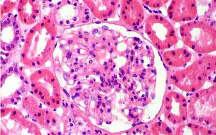 小肠间质瘤伴肾小球系膜增生