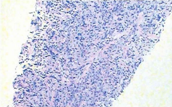 原发纵隔大B细胞淋巴瘤