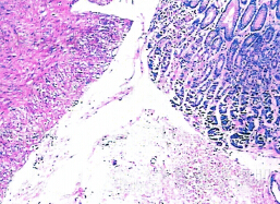 食管交界性平滑肌瘤